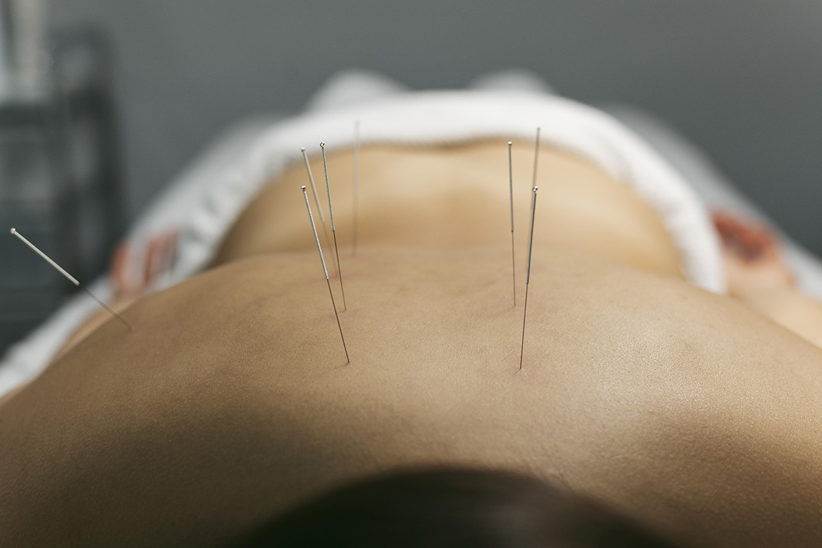 London Acupuncture
